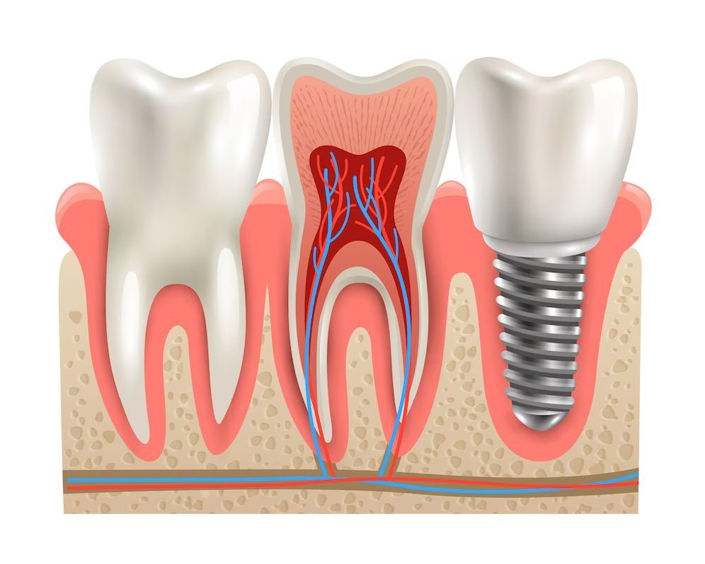 A diagram of a tooth with a dental implant in it.