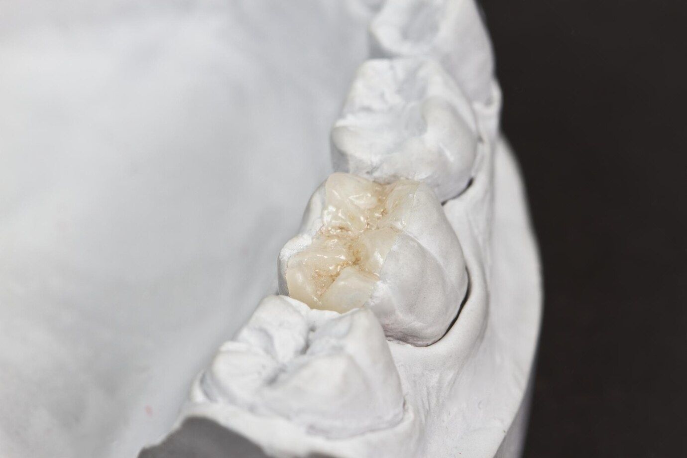 A close up of a model of a tooth with a filling in it.
