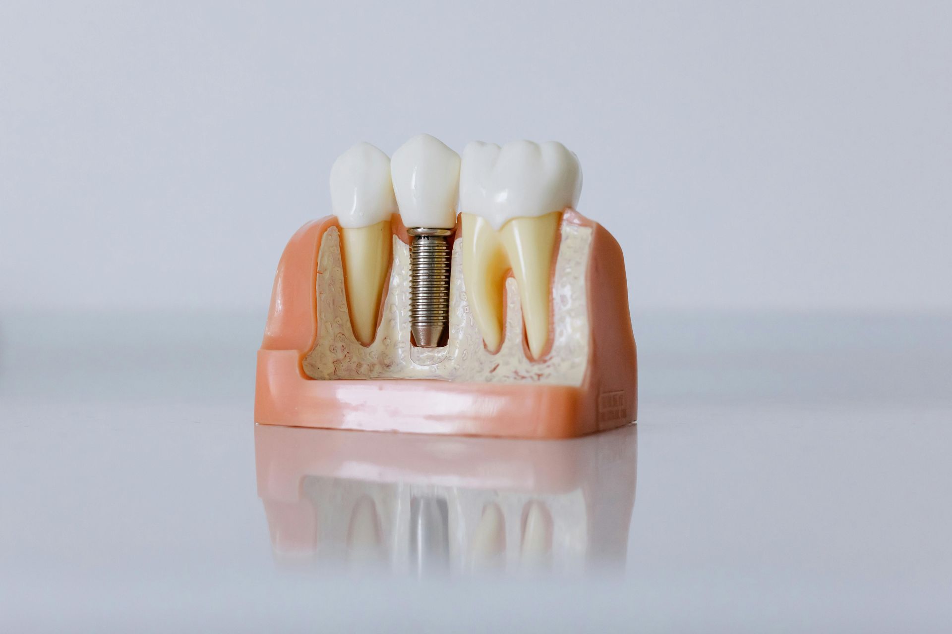 Model of teeth and gums, showing how a dental implant works and how it is inserted