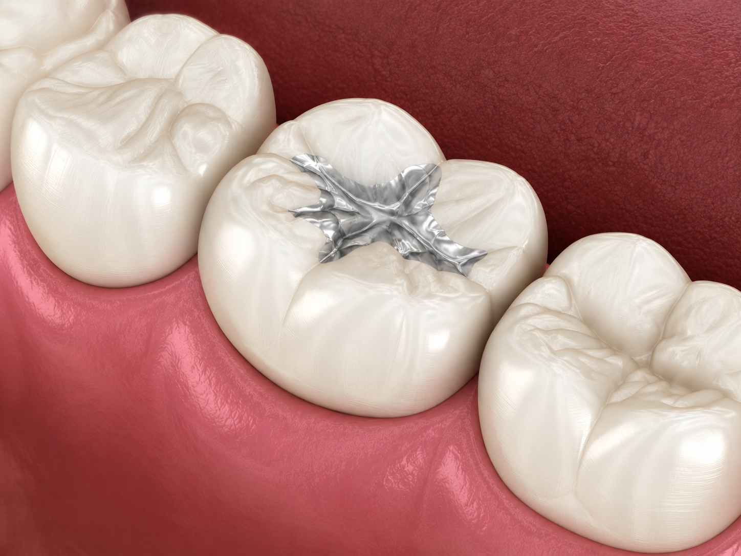 Close-up of molars with a silver dental filling on pink gums
