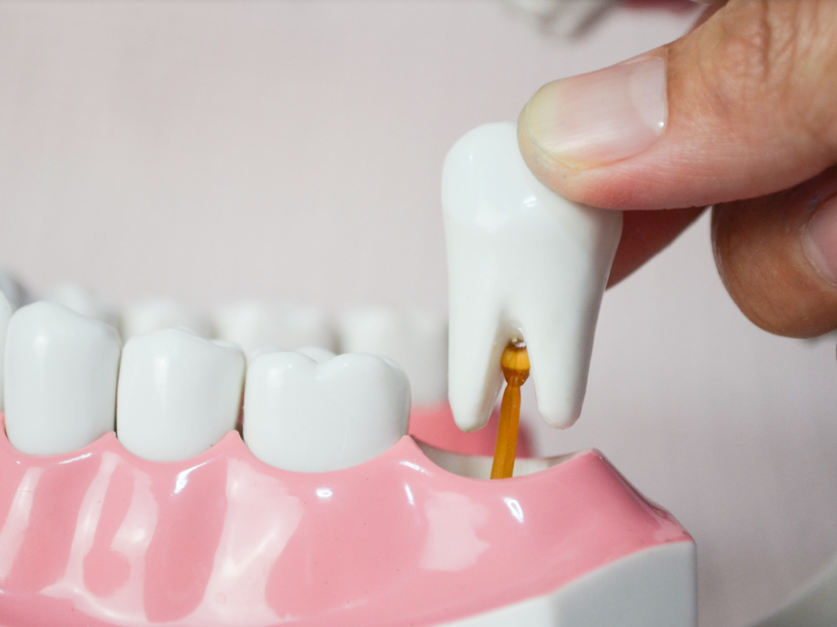Get tooth removal at our top family dentist in Morgantown WV A person is holding a model of a tooth in their hand.