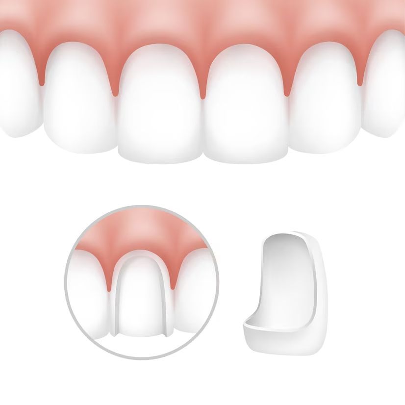 A close up of a person 's teeth and a dental crown.