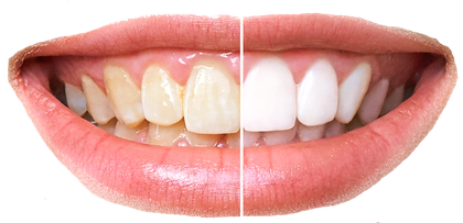Teeth Whitening