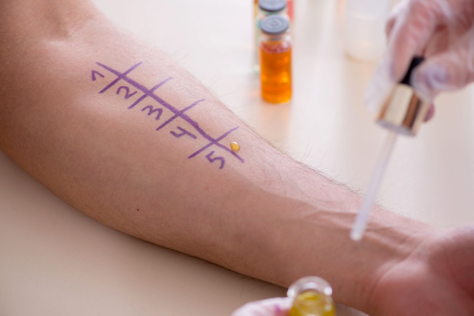 Doctor testing allergy reaction of patient