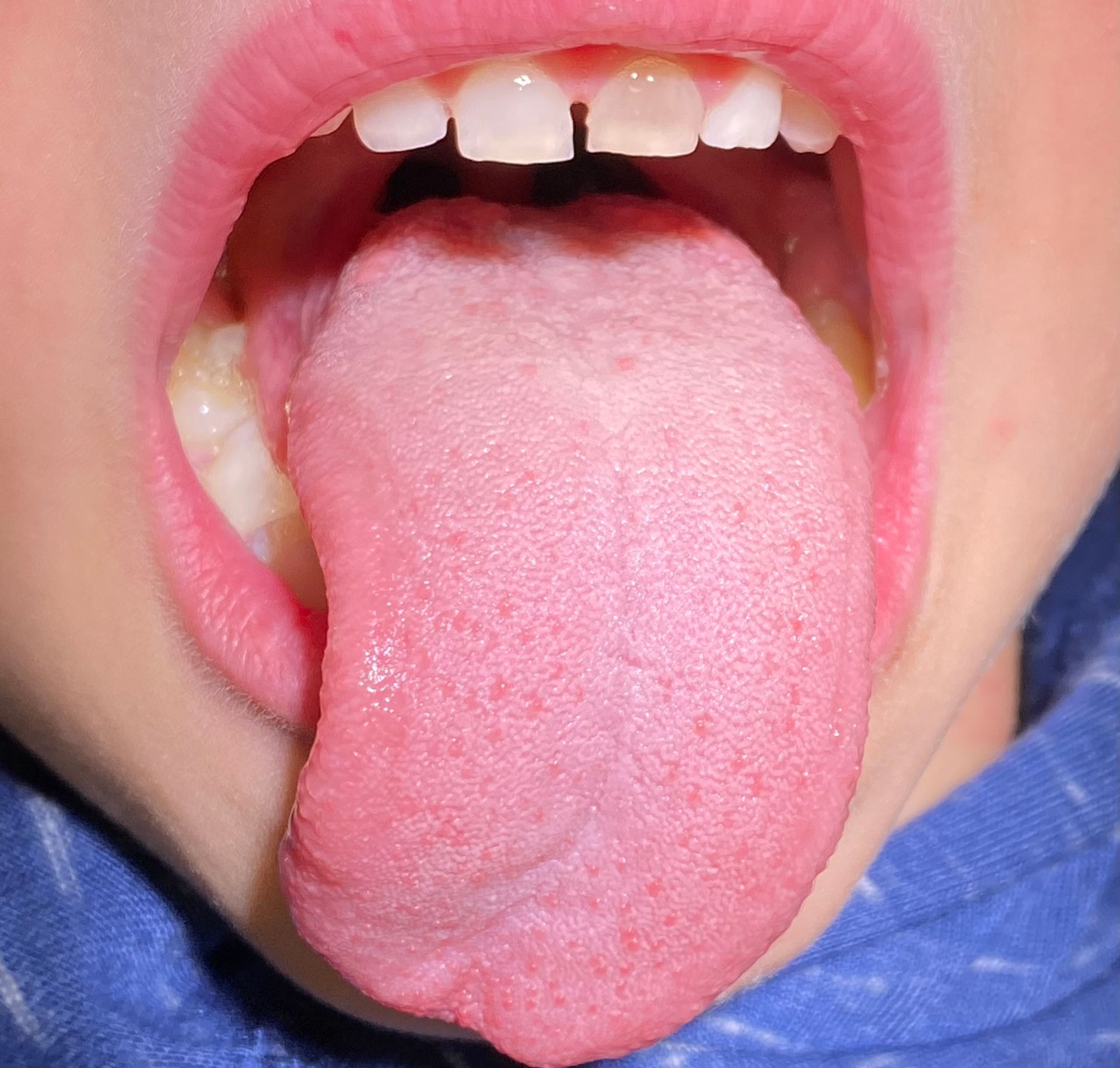 Close-up of a child sticking out their tongue, with missing front teeth visible.
