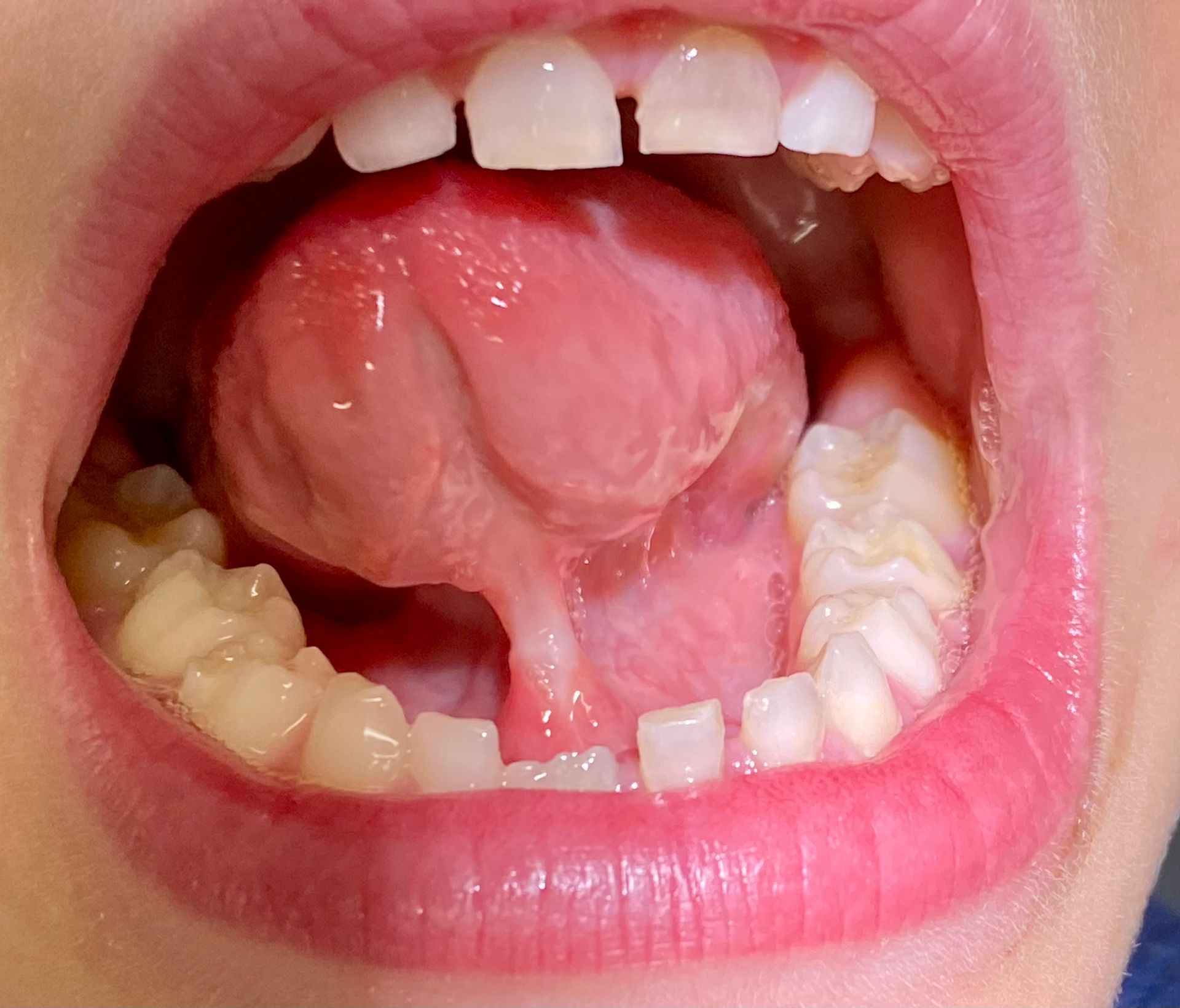 Open mouth showing tongue and teeth, with the front upper tooth missing