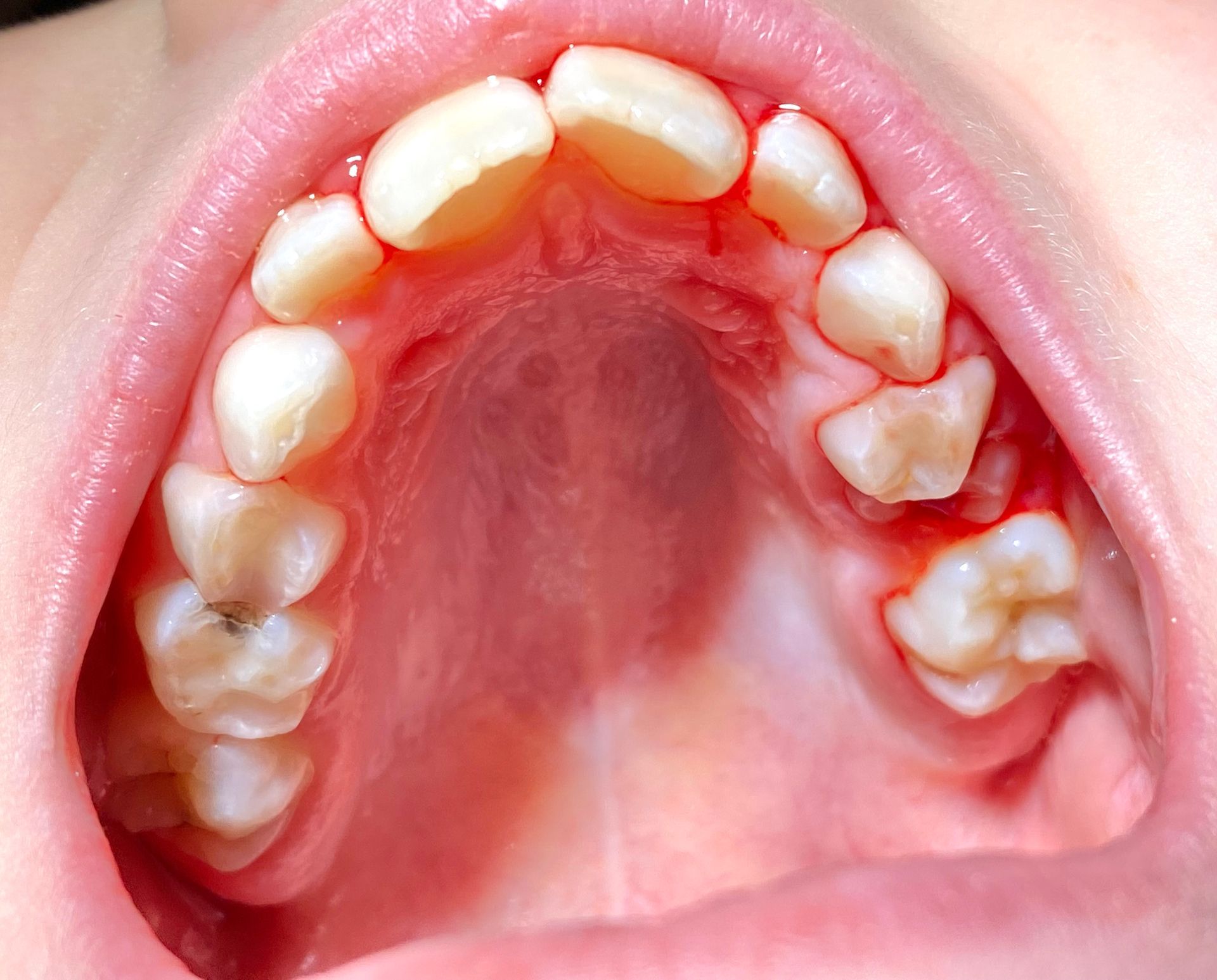 Top view of an open mouth showing upper teeth and pink palate, with visible dental crowding and gaps