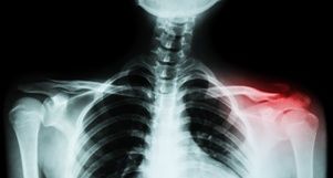 broken collarbone caused by Euless crash