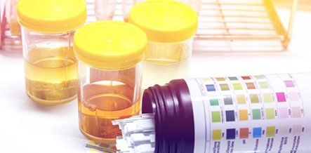 Urine Sample — SE Decatur, AL — Alabama Urology and Robotic Center Urine Sample — SE Decatur, AL — Alabama Urology and Robotic Center