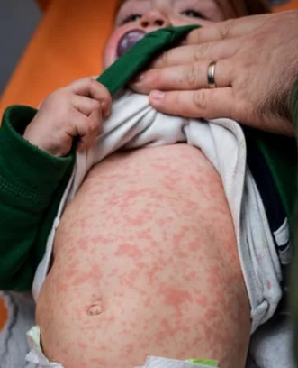 Baby with red rash on belly while an adult lifts shirt to show skin.