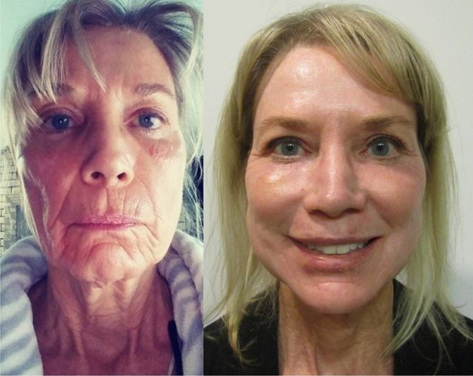 CO2 Laser with Full Fat Package with Non-Incision — Dearborn, MI — Masri Clinic