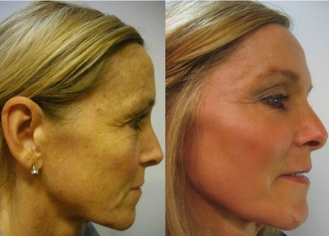 CO2 Laser with Full Fat Package — Dearborn, MI — Masri Clinic