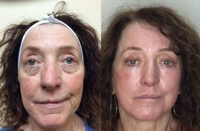 Senior Woman with CO2 Laser — Dearborn, MI — Masri Clinic