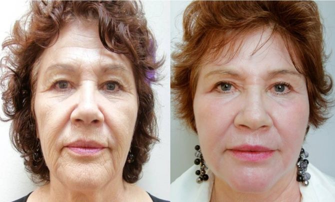 CO2 Ultrapulse Skin Resurfacing — Dearborn, MI — Masri Clinic