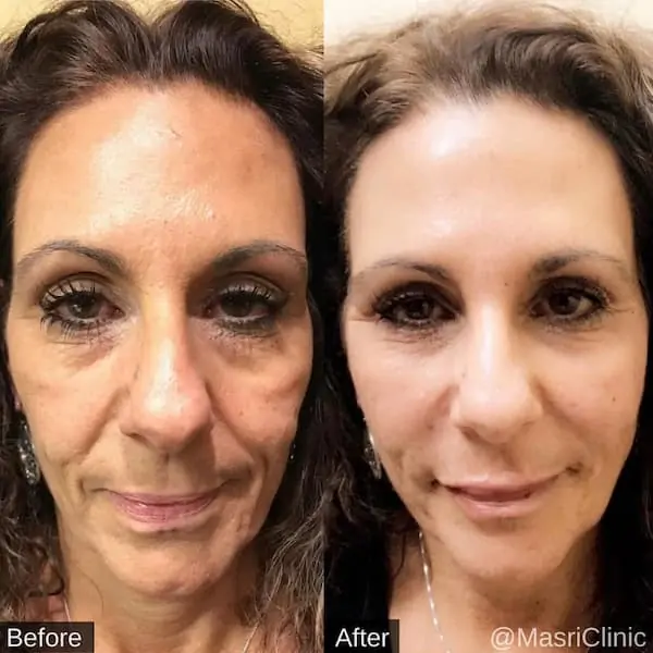 Before and After Voluma Liquid Facelift — Dearborn, MI — Masri Clinic
