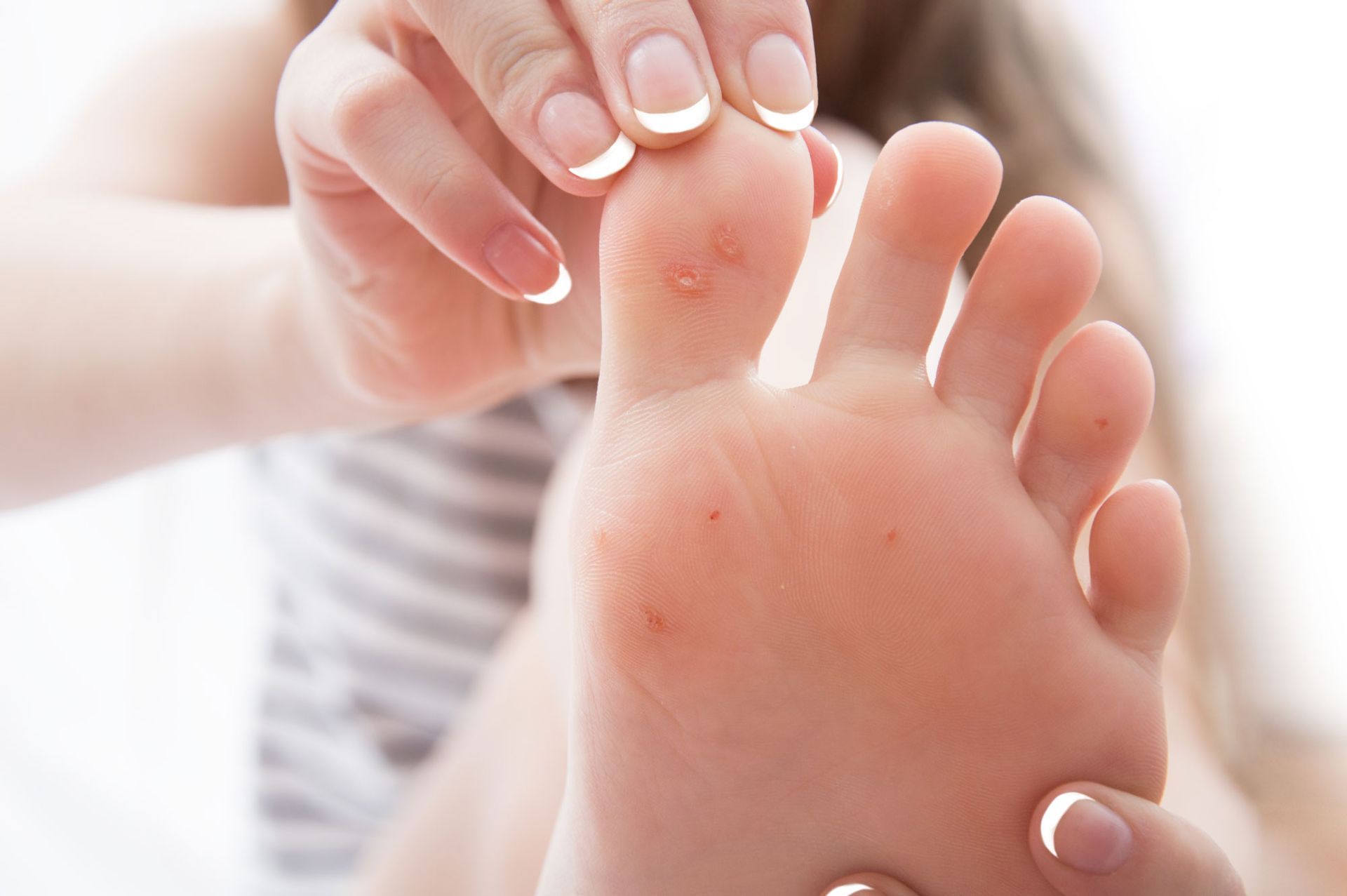 Corns & Calluses