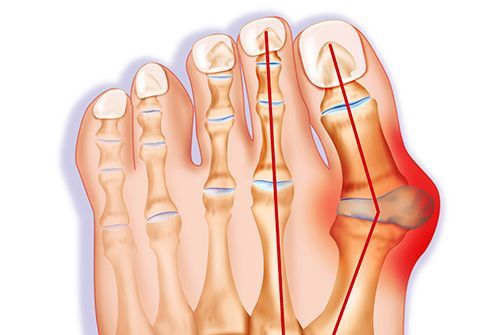 LapiFuse™ BUNION CORRECTION