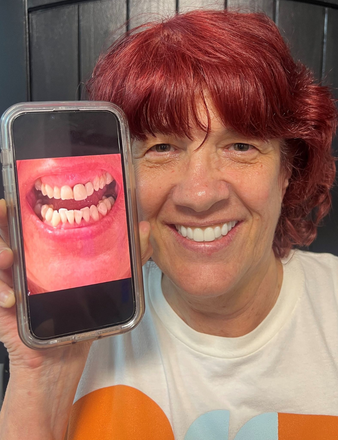Person holding phone showing before/after teeth photos. The person smiles, showing perfect white teeth.
