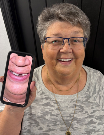 Woman holding phone displaying photo of missing teeth, smiling.