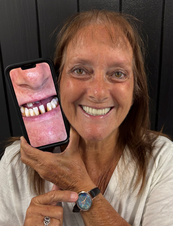 Woman holding phone with image of her damaged teeth; smiling, wearing watch.