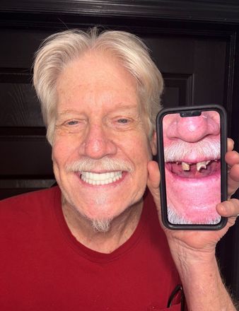Man holding phone showing his before dental work. Smiling, wearing red shirt.