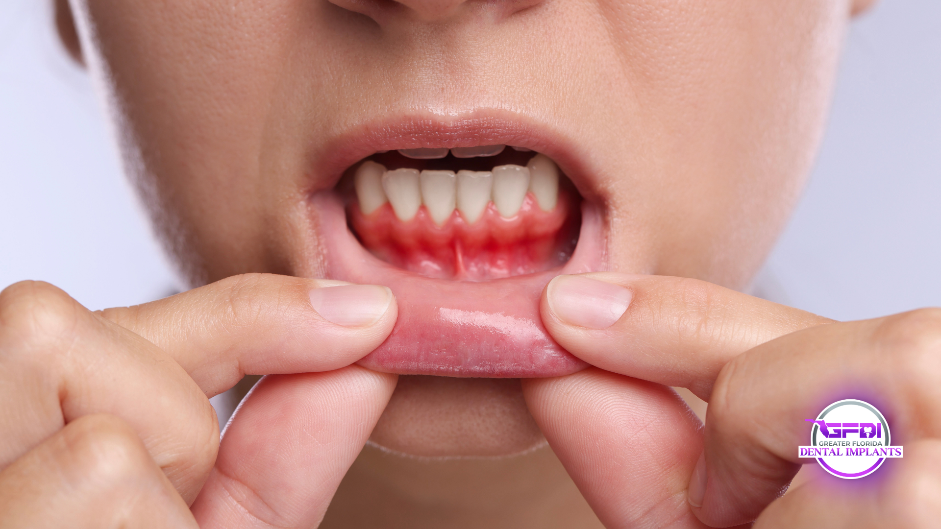 Close-up of a person pulling down lower lip to show teeth and gums.