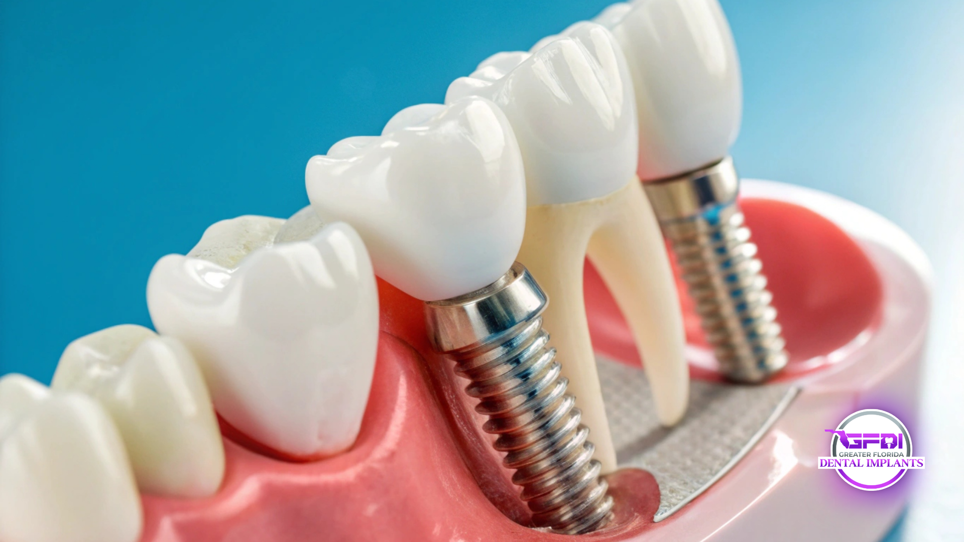 Model of teeth with dental implants; white teeth, metal screws, pink gum, blue background.