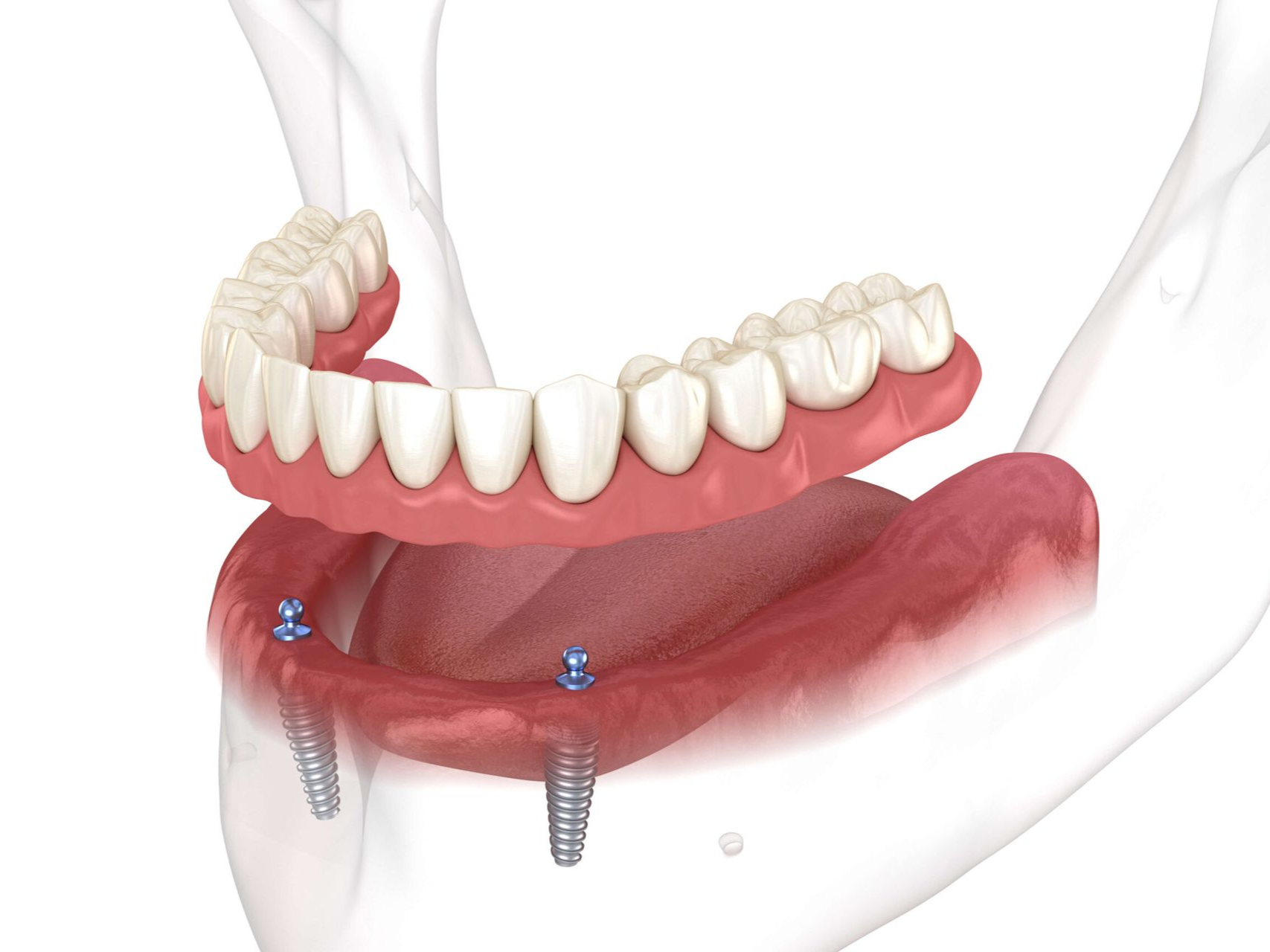 Illustration of dental implants and a complete denture in the lower jaw, showing pink gums and white teeth.