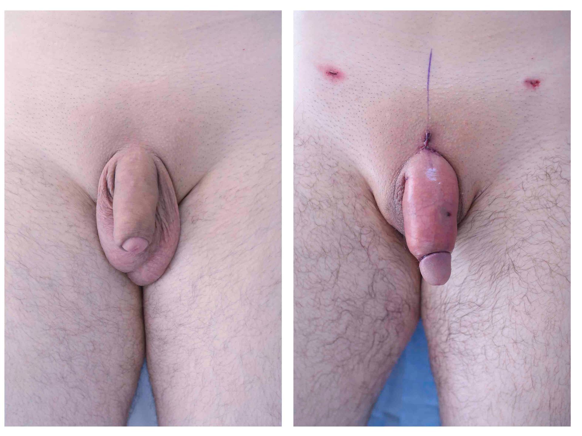 penoplastia mexico