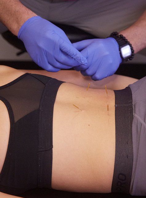 Inserting Filament Needles — Wichita, KS — Advanced Chiropractic Inserting Filament Needles — Wichita, KS — Advanced Chiropractic