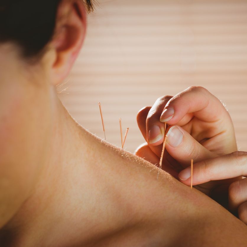 Woman getting acupuncture treatment Woman getting acupuncture treatment