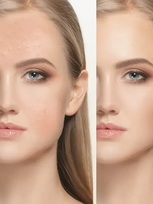 A before and after picture of a woman 's face with acne.