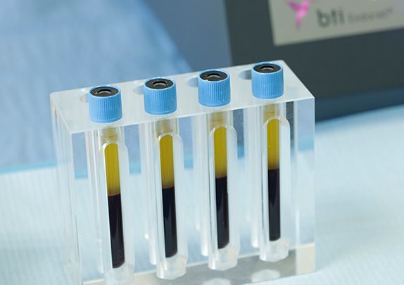 PRP (plasma ricco di piastrine)