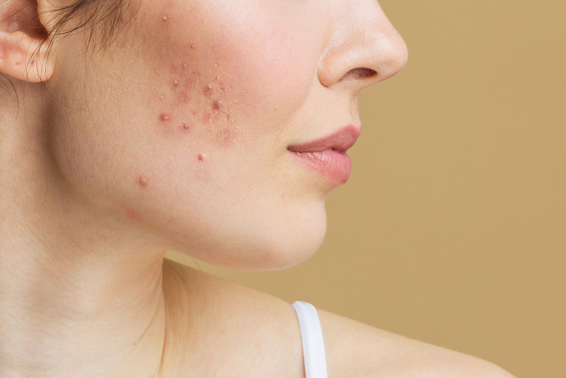 ragazza con acne