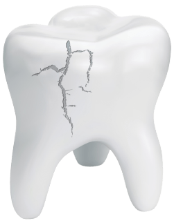 Cracked tooth