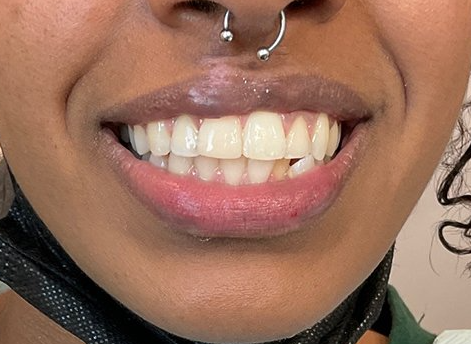 after dental bonding