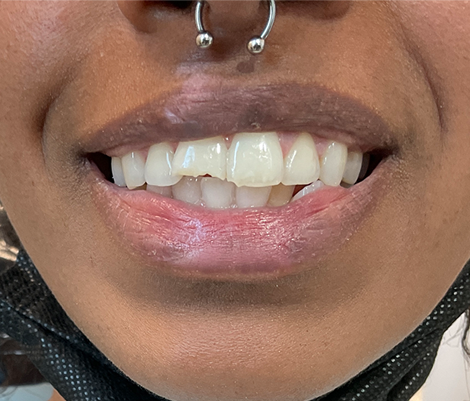 before dental bonding