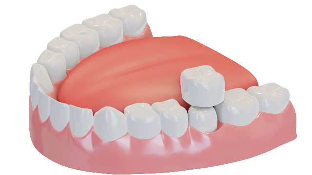 dentures