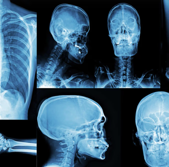 Collage of blue-tinted X-ray scans showing skull and neck from multiple angles