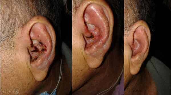 DR. RODRIGO CASTRO MARTÍNEZ - INFECCIONES DEL OÍDO