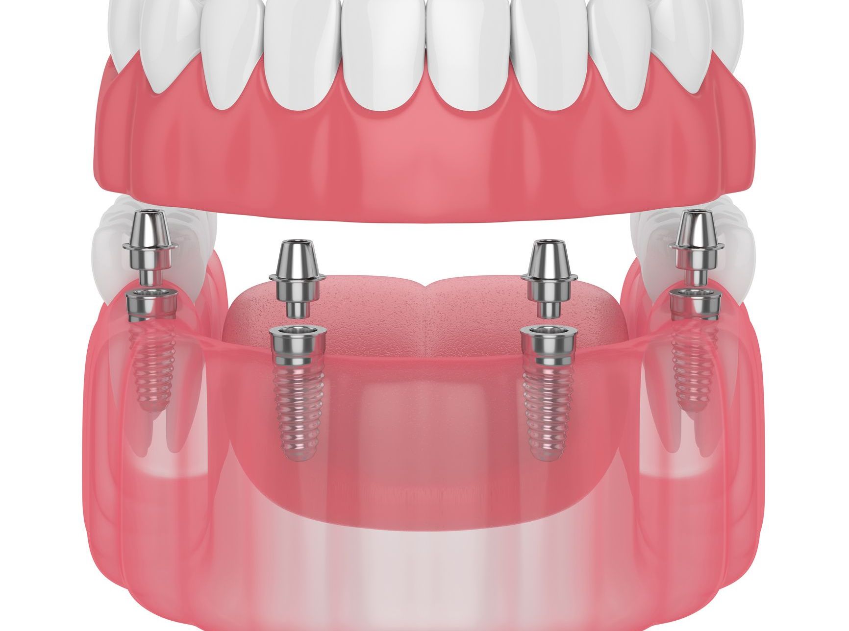 A 3d rendering of a full denture with four dental implants.