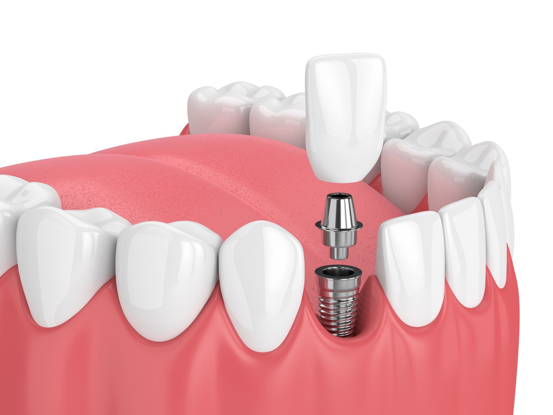 A 3d rendering of a dental implant in a tooth.