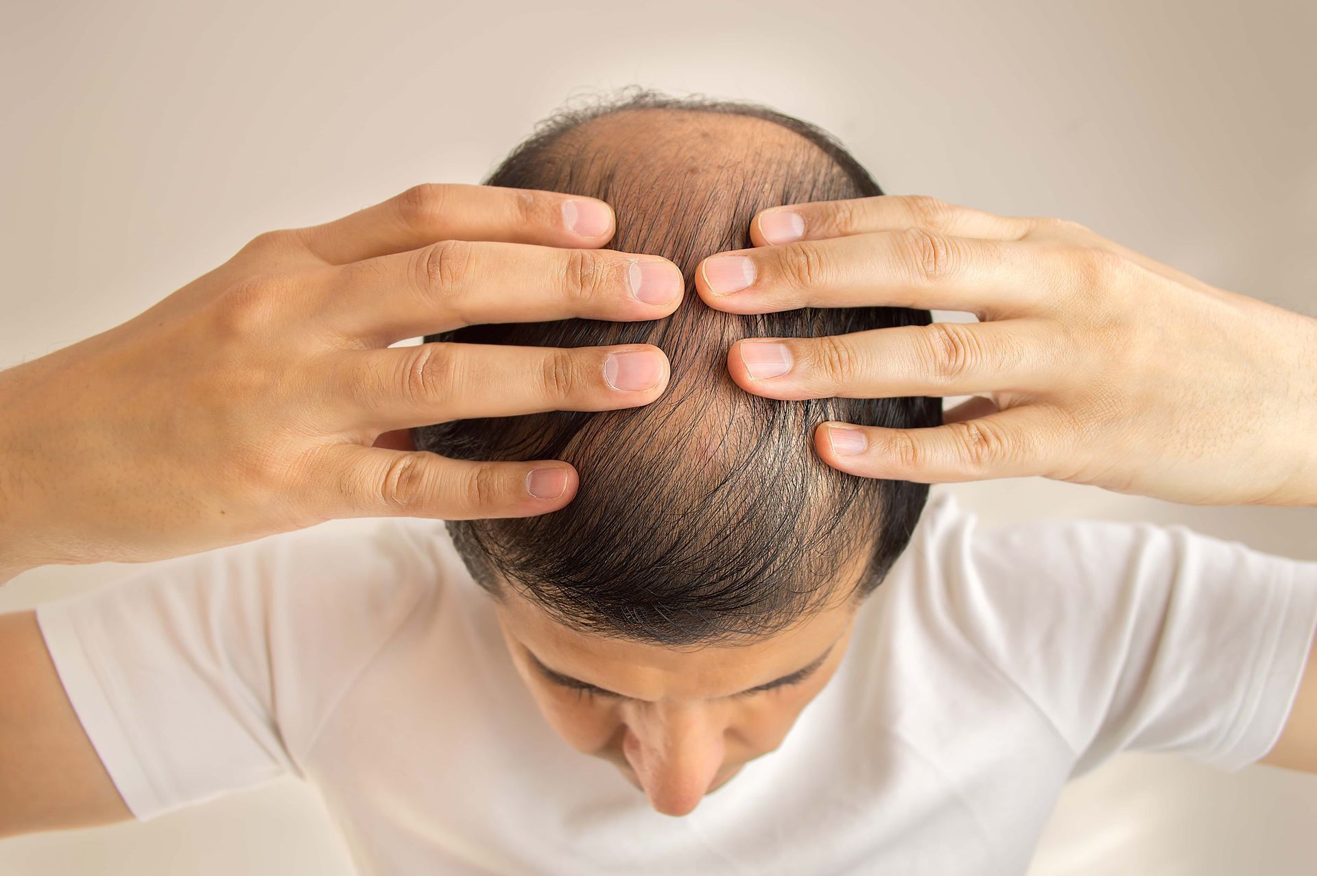 Person examining a thinning scalp with both hands, viewed from above on a white background