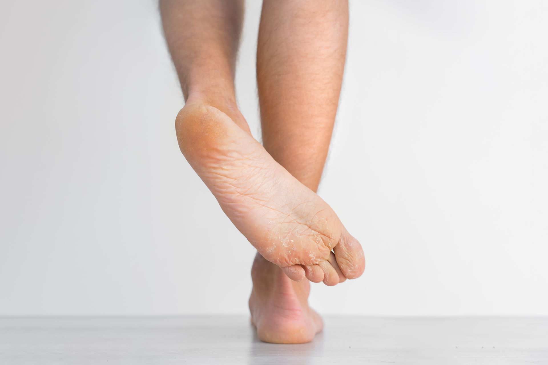 Bare feet, one crossed over the other, against a plain white backdrop. Dry skin visible on the soles.