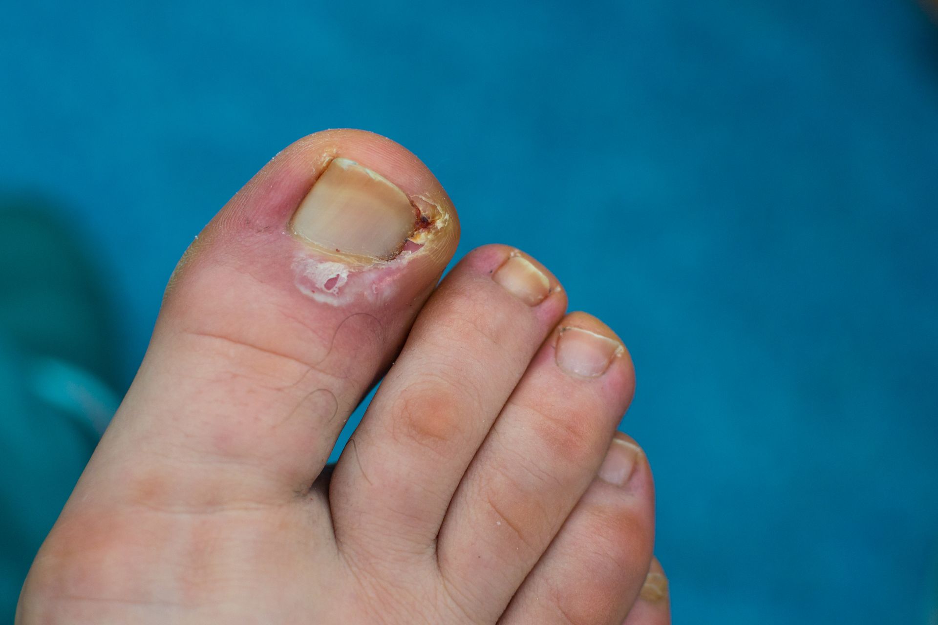 Toe with an infected, damaged nail, showing redness and possible pus, against a blue background.