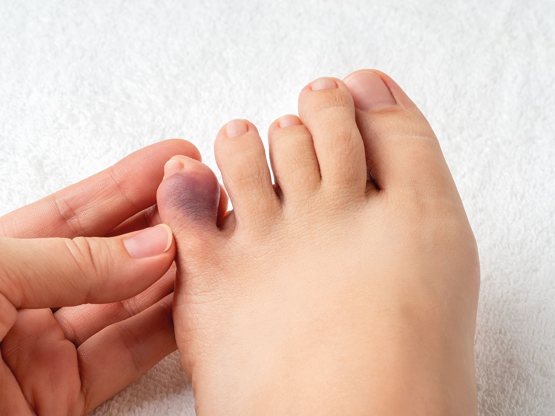 Toe with a large purple bruise, being held by a hand.