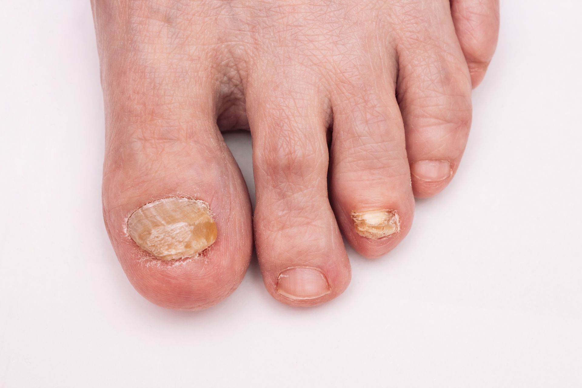 Foot with toenail fungus; large toenail is yellowed, thick, and discolored.