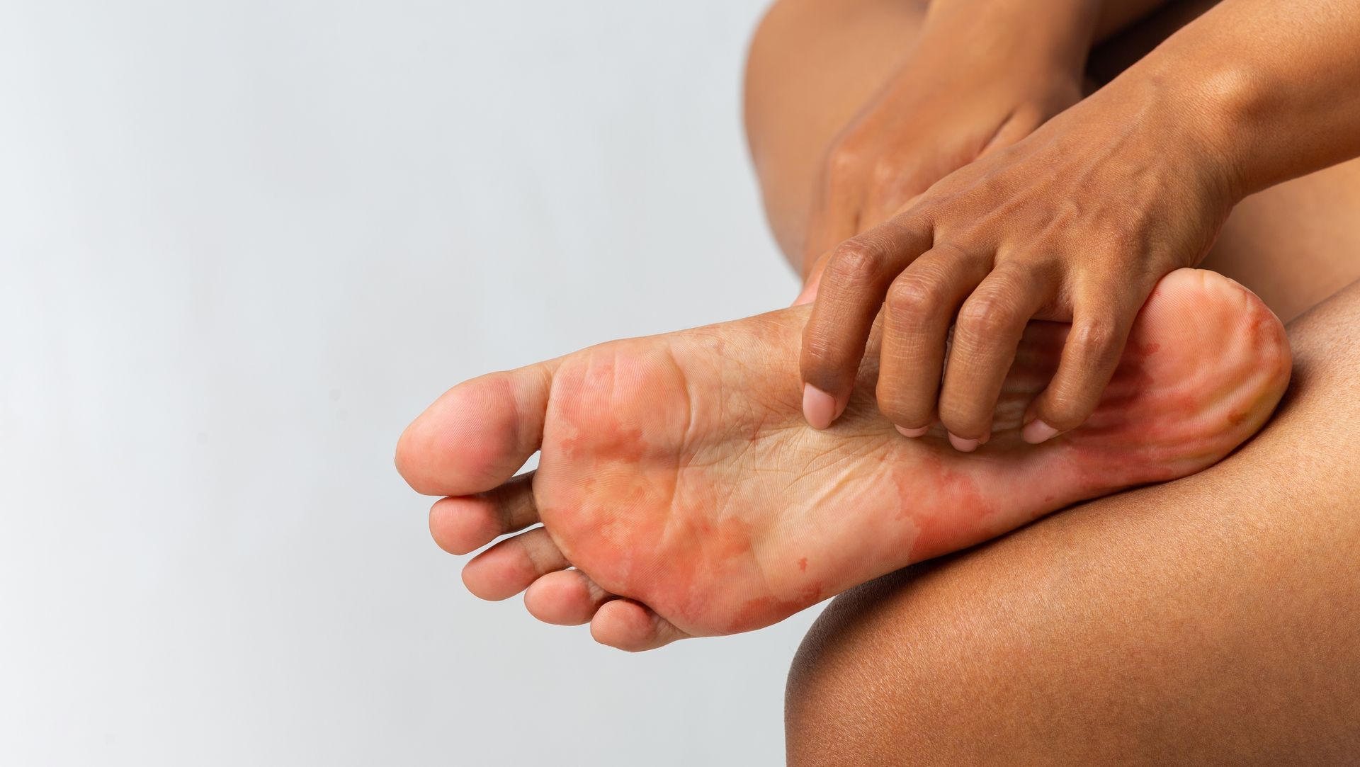 Person's hand scratching the bottom of their foot, which is red and appears irritated.