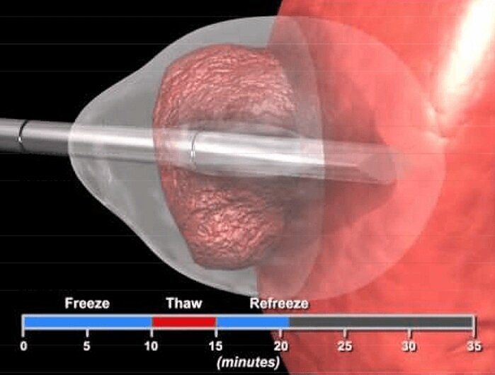A computer generated image of a freeze thaw and refreeze process