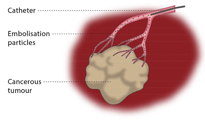 A diagram of a catheter being inserted into a cancerous tumour